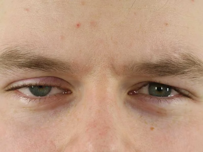 IJver helpen geboorte Ptosis bovenooglid (hangend ooglid) - Augenärzte Gerl & Kollegen -  augenklinik.de